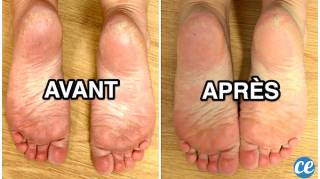 L'Astuce au Bicarbonate de Soude Pour Avoir des Pieds Tout Doux