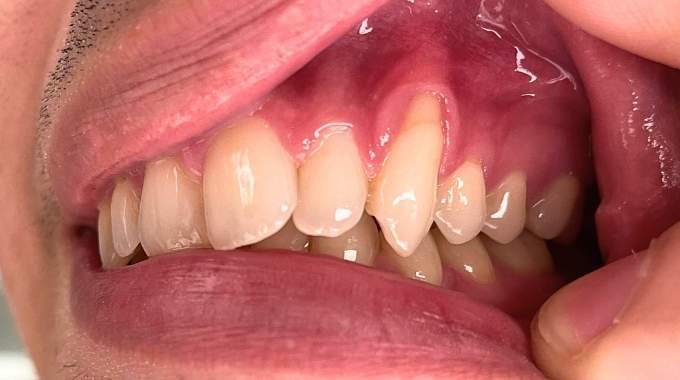 12 Remèdes de Grand-Mère Contre le Déchaussement des Dents.