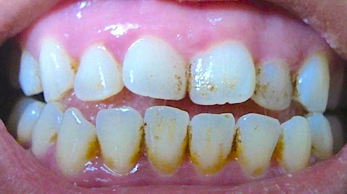 J'ai Testé 8 Astuces pour Éliminer les Taches sur mes Dents et la Meilleure est Inattendue.