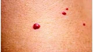 Si Vous Remarquez Ces Points Rouges sur votre Peau Voici Ce Qu’ils Signifient