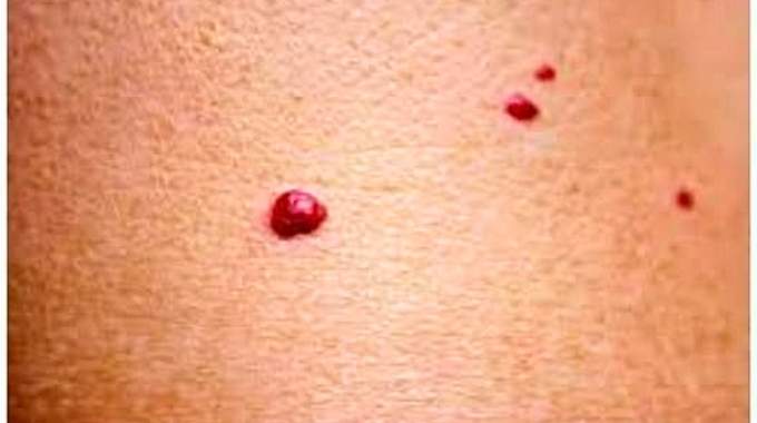Si Vous Remarquez Ces Points Rouges sur votre Peau, Voici Ce Qu’ils Signifient.