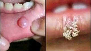 Des Remèdes de Grand-Mère pour Soigner l'Herpès Labial Naturellement