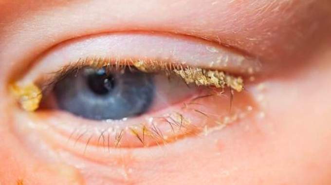 La Plupart des Gens Ne Savent Ce Que Signifie la Croute Jaune Qui Apparait sur les Yeux au Réveil.