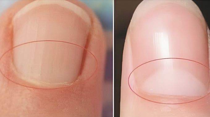 Que signifie la demi-lune blanche à la base de l'ongle ?