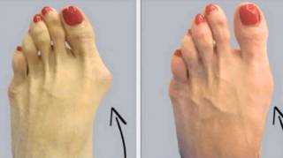 Comment soulager naturellement l'hallux valgus ou oignon de pied
