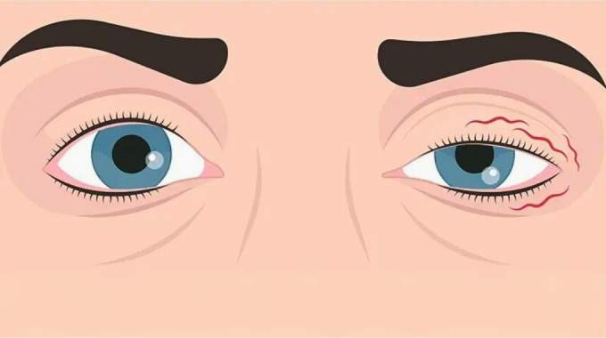 Pourquoi ma paupière saute ? Voici ce que votre corps essaie de vous dire