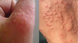 Si vous avez ces petits points rouges sur le bras cela peut révéler un problème sérieux