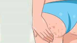 Boutons aux fesses : 4 conseils pour vous en débarrasser à tout jamais