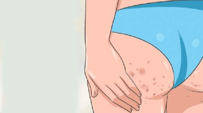 Boutons aux fesses : 4 conseils pour vous en débarrasser à tout jamais