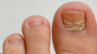L’astuce de ma grand-mère pour réduire l'épaisseur des ongles des pieds testée et validée par des podologues