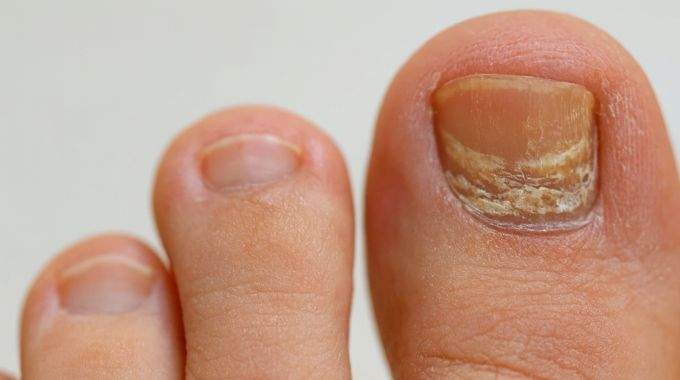 L'astuce pour réduire l'épaisseur des ongles des pieds