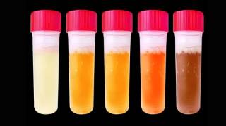 Les 3 couleurs d'urine qui pourraient indiquer la présence d'une maladie