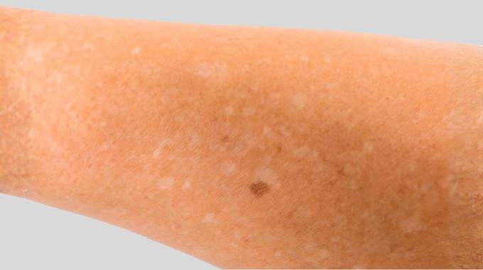 Avez-vous d&eacute;j&agrave; remarqu&eacute; de petites taches blanches sur vos bras ou vos jambes ? Ce que dit un dermatologue va vous rassurer