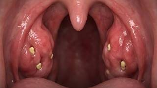 Pourquoi ces 'petites pierres blanches' malodorantes apparaissent-elles dans la bouche