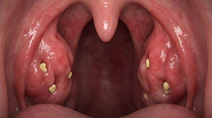 Pourquoi ces 'petites pierres blanches' malodorantes apparaissent-elles dans la bouche