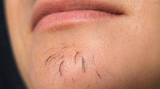 Les poils au menton chez la femme sont le signe de