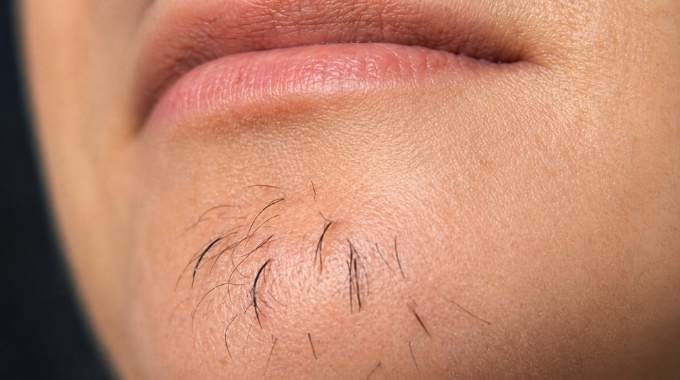 Les poils au menton chez la femme sont le signe de