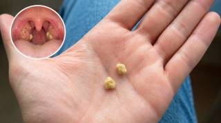 Pourquoi certaines personnes expulsent-elles de petites boules malodorantes de leur gorge