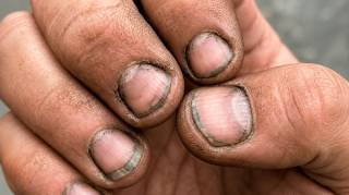 Comment appelles-tu une personne qui a les ongles ainsi