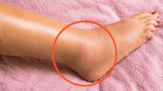 Jambes gonfl&eacute;es : ce signal d'alerte que votre corps vous envoie (et quand s'inqui&eacute;ter)