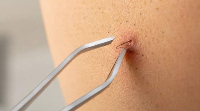 Un m&eacute;decin alerte sur les dangers d'arracher les poils incarn&eacute;s (voici ce qu'il faut faire &agrave; la place)