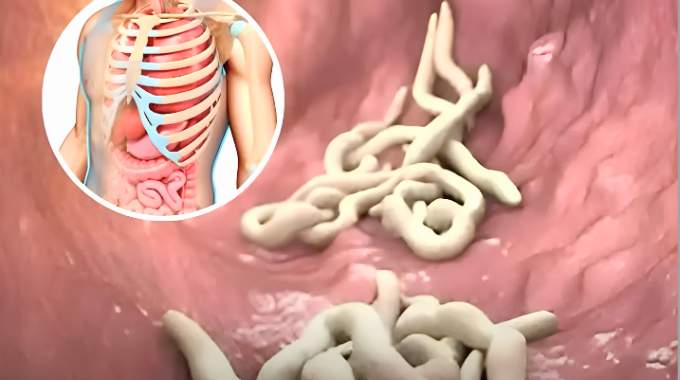 10 signes que votre corps est infest&eacute; de parasites et 7 aliments pour les &eacute;liminer