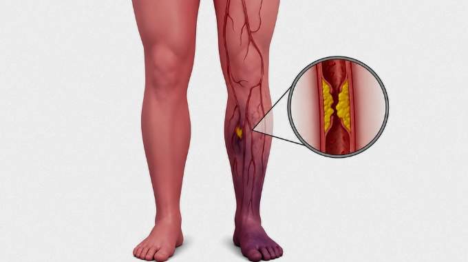 10 alertes d'un caillot sanguin dans la jambe
