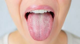 Soigner un muguet buccal chez l'adulte et l'enfant