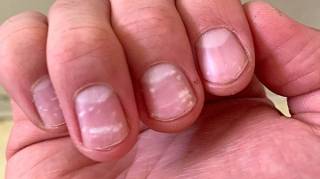 Taches blanches sur les ongles : quelle est la signification