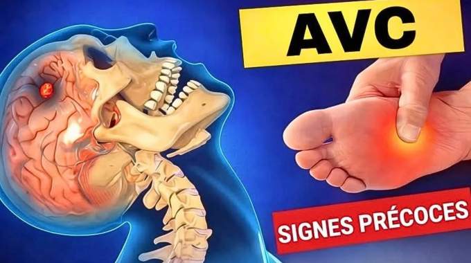 Reconna&icirc;tre les premiers signes avant-coureurs d'un AVC peut contribuer &agrave; sauver des vies et &agrave; pr&eacute;venir des handicaps