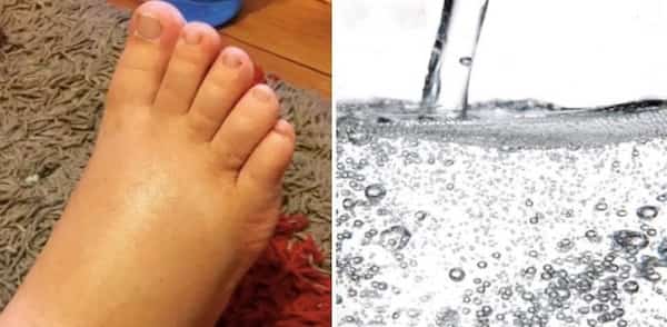 &eacute;viter les pieds gonfl&eacute;s quand on est enceinte