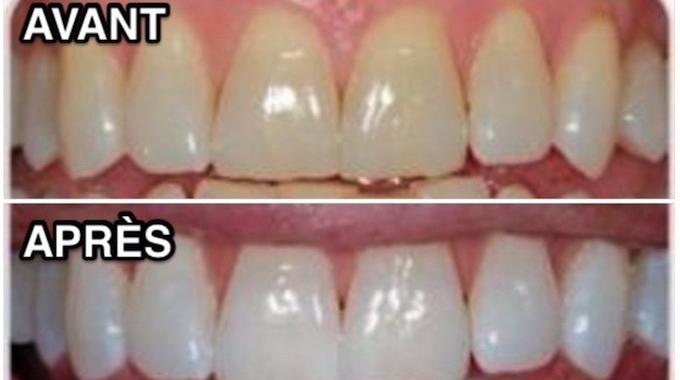 Comment Avoir des Dents Blanches EN UN RIEN DE TEMPS :-)