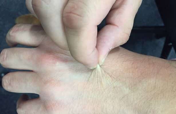 test de la peau déshydratée