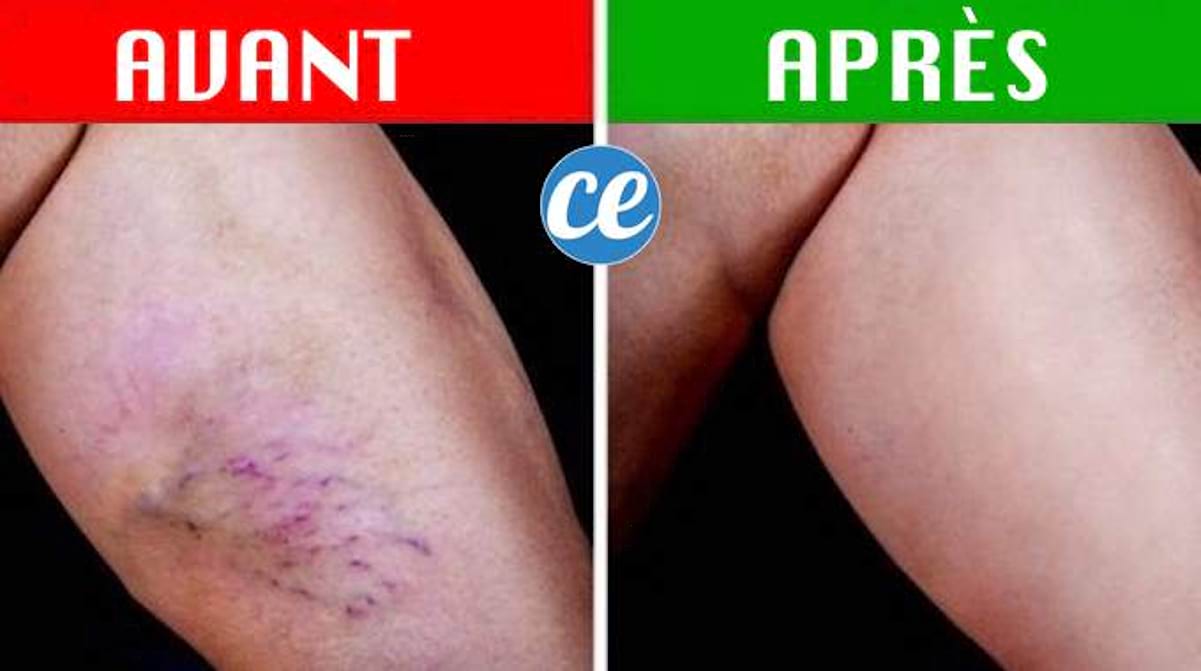 soigner les varices