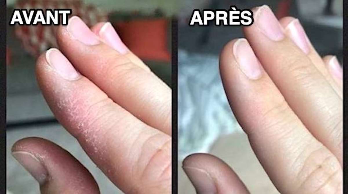 Mains Sèches à Cause Du Froid ? Le Remède Naturel Super Efficace