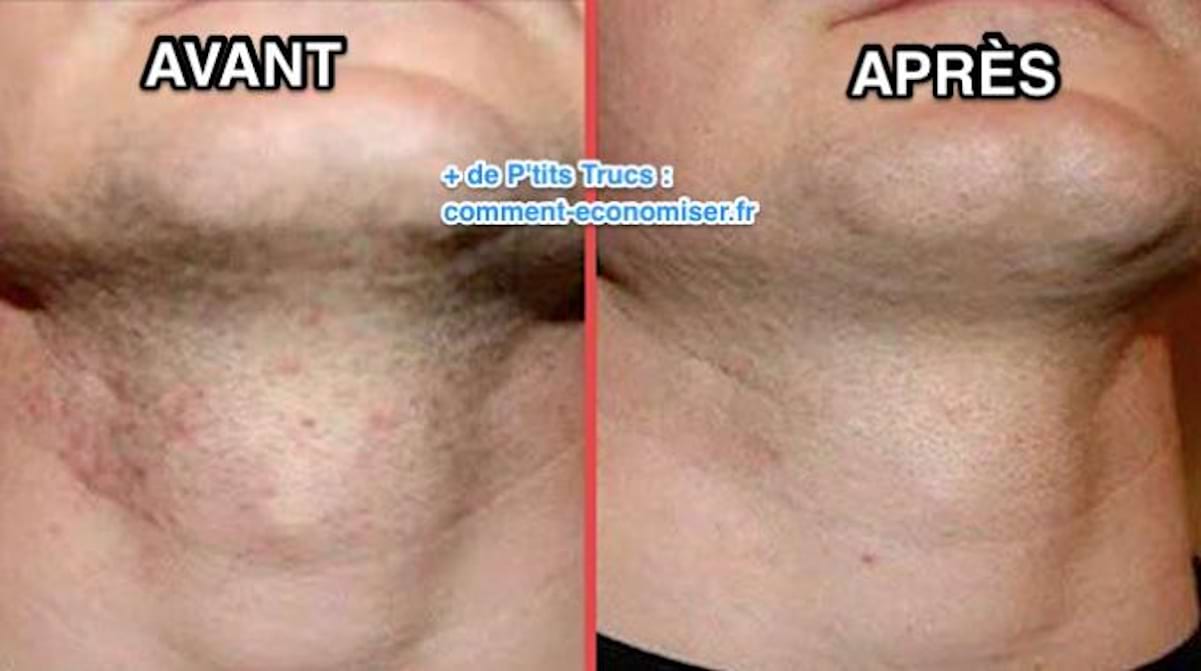 Comment Faire Apres Rasage Pour Ne Pas Avoir Des Rougeure