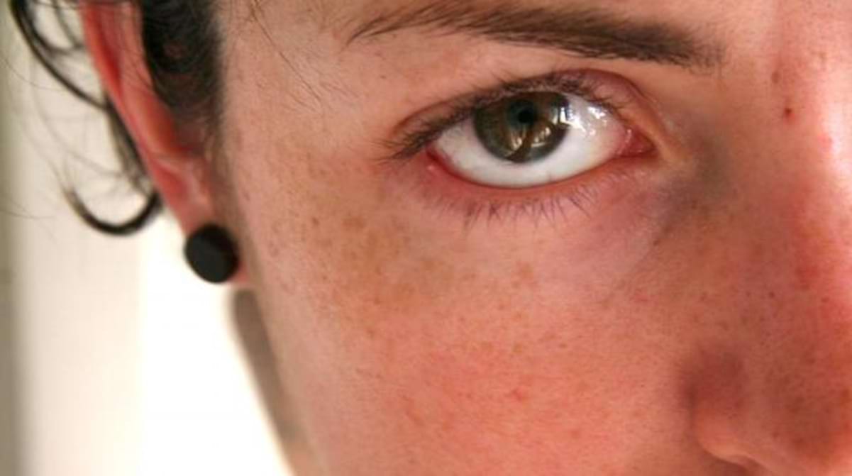chalazion et bague en or chalazion et bague en or